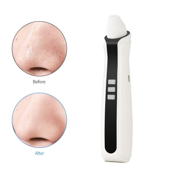 USB Rechargeable Blackhead Remover Vacuum - Image 4