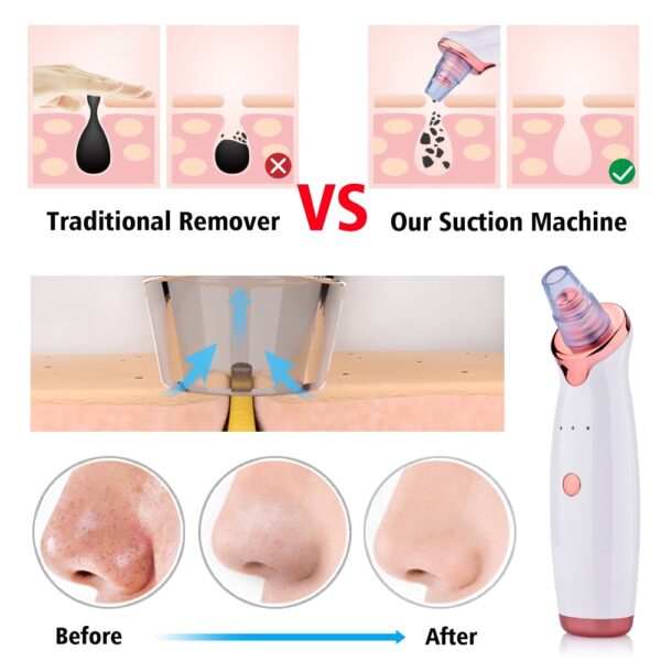 Blackhead Removing Vacuum Tool - Image 7