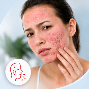 Close-up of a young person with mild acne and pimples on their cheek, touching their face gently.